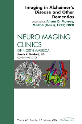 Síndrome de Down y Alzheimer: ¿Cómo se relacionan?